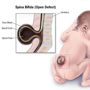 Spina bifida