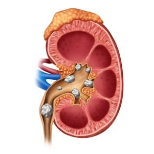 Bladder exstrophy