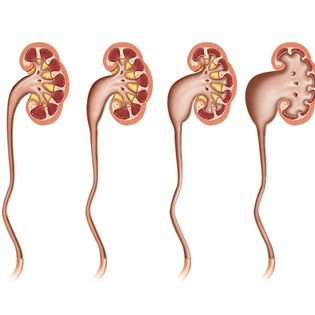 Hydronephrosis (kidney dilation, detected prenatally or in childhood)