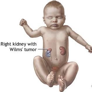 Pediatric stone disease