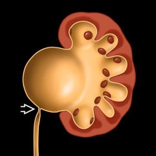 Uretero pelvic junction obstruction