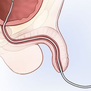 Adult Hypospadias