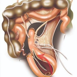 Neobladder Surgery