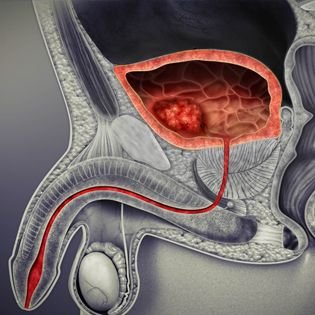 Penile and Urethral Preservation Surgery