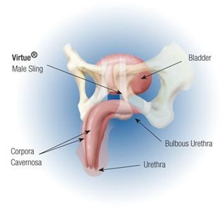 Surgery for Male Urinary Incontinence