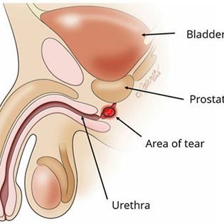 Urethral injuries from pelvic fracture