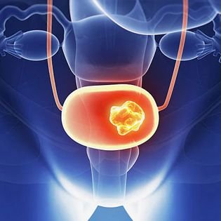 Bladder Cancer Treatment