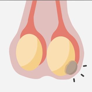 Testicular Tumor Treatment